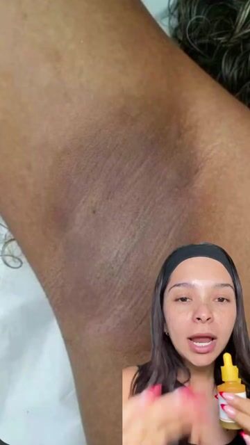 Video de SkinFree