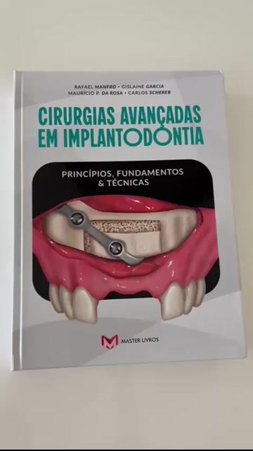 Vídeo de Cirurgias Avançadas Em Implantodontia - Princípios, Fundamentos E Técnicas - Rafael Manfro, Gislaine Garcia, Mauricio P. Da Rosa e Carlos Scherer